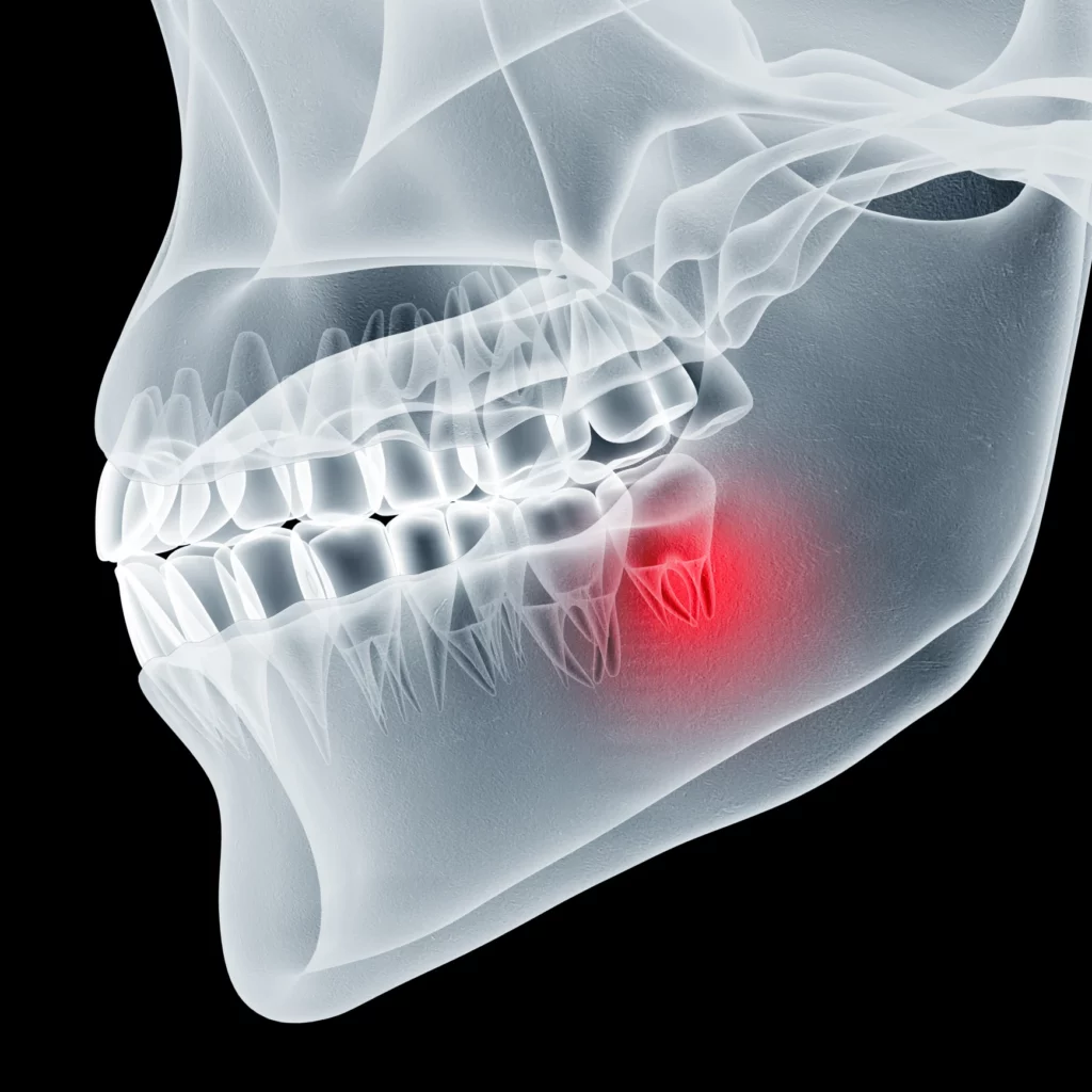 wisdom teeth removal in Chester Springs, PA
